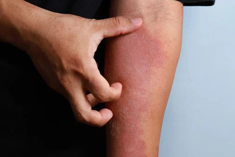 How Swimming Pool Chemicals Affect Hair, Skin, and Nails